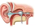 Schéma de l'oreille montrant comment se boucher les oreilles sans boule quies, avec un appareil bloquant les ondes sonores.